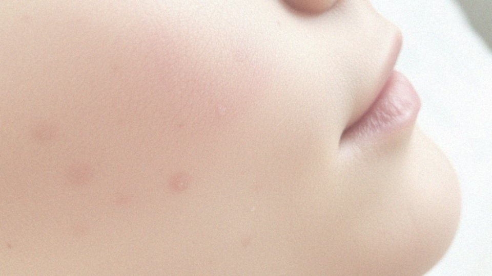 Jakie są objawy wysypu po zabiegu dermapenem?